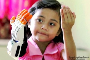 UPDATE: Hand-less Malaysian kid receives new hands from 3D Printer! OMG!