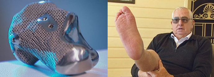 world's first 3D-printed titanium replica of a heel. len chandler. Images from ABC News