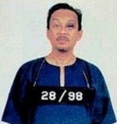 anwar-ibrahim-mata-lebam