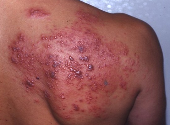 scabies-outbreak-illegal-immigrants