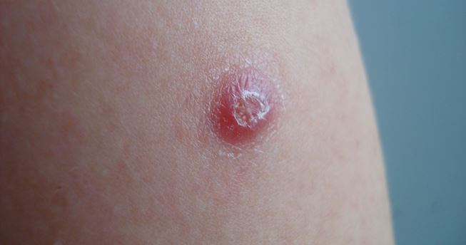BCG scar mark rash. Image from thetraveldoctor.com.au.