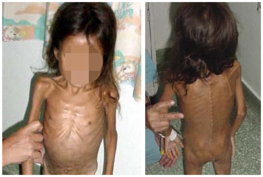 A 7-year old OA child malnourished due to poverty. Source