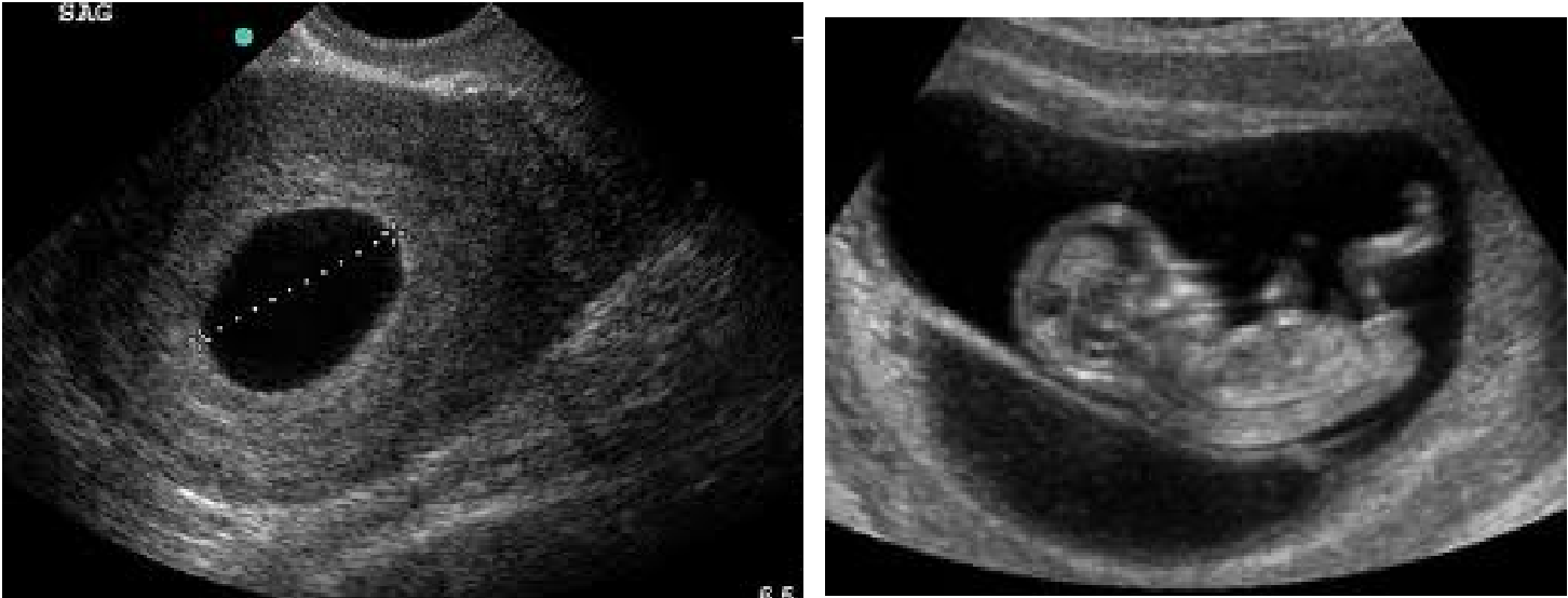 blighted ovum ultrasound foetus baby