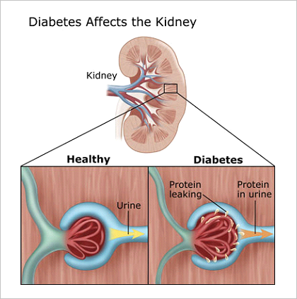 diabetic kidney disease