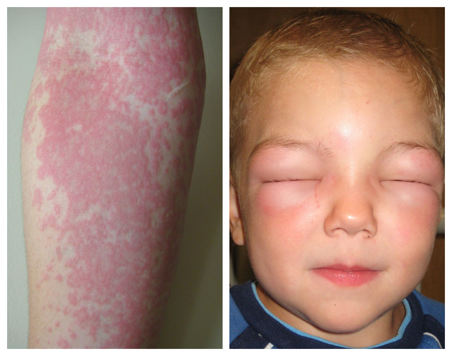 Hive rash (on the left) and a more serious rash, Anaphylaxis (on the right). Images from Wikipedia by John D