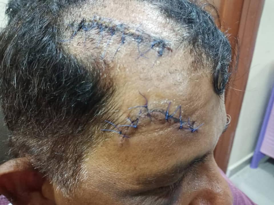 Her dad was slashed in the head by the robbers. Img from Thivyah Velurajan's Facebook