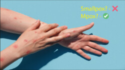 Common Mpox symptoms that Malaysians should keep in mind